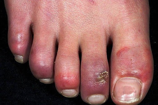 Do you know about Chilblains?
