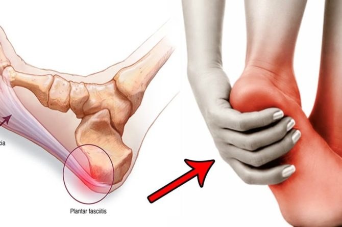 What Is Planter Fasciitis?