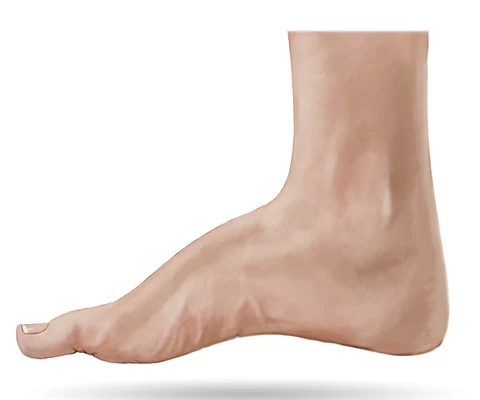 High Arch Foot Treatment