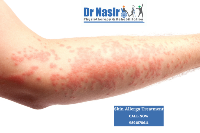 Skin allergy treatment in vikaspuri Tilak Nagar Janakpuri Rajouri Garden