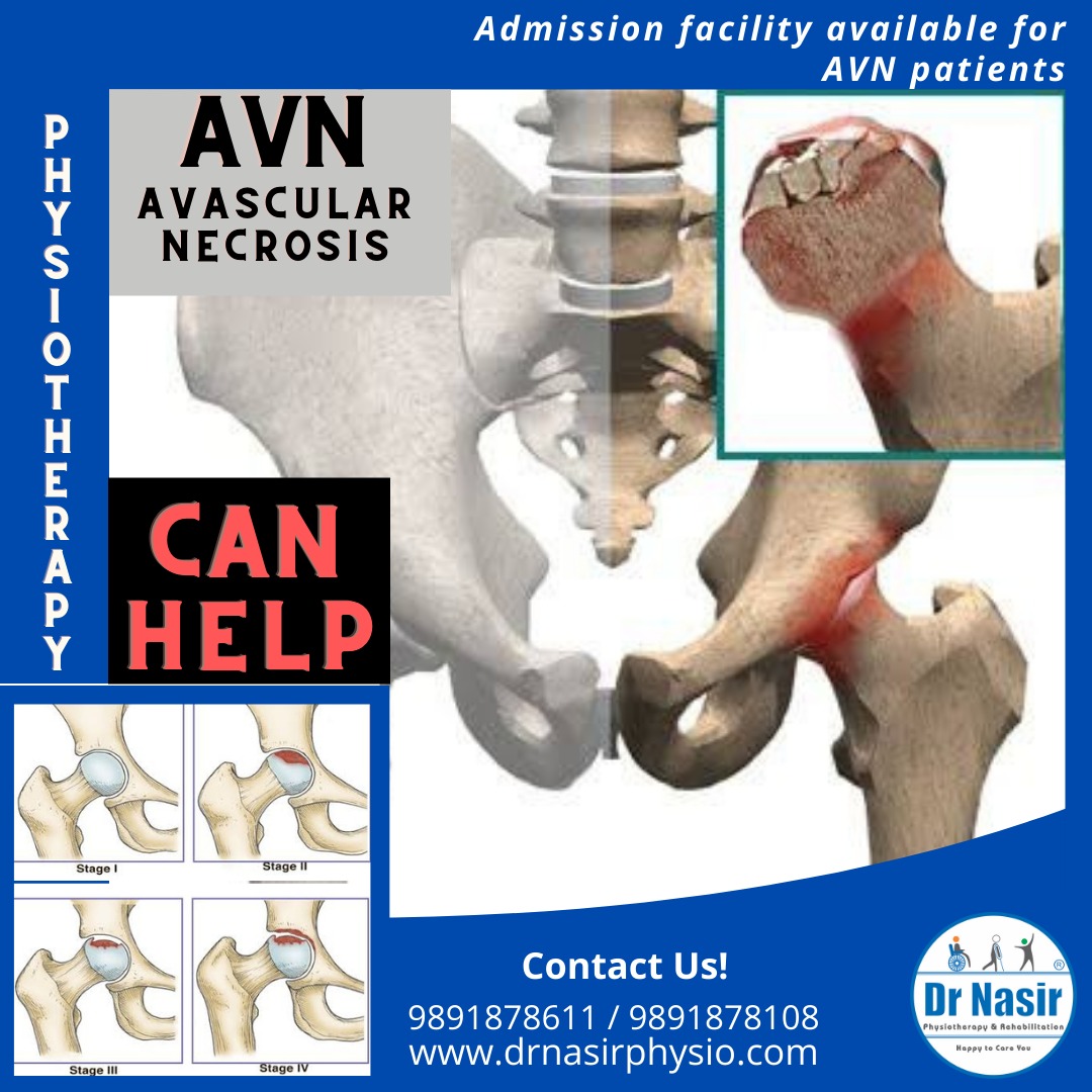 Avascular Necrosis Avn Dr Nasirphysiotherapy And Rehabilation