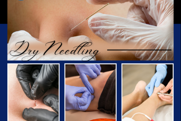 What is Dry Needling?